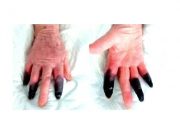 Paciente sofre rara reação à covid-19 e tem 3 dedos amputados