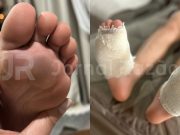 Criança volta com os pés queimados da escola em Canelinha e desabafa: “eu pedi para parar”