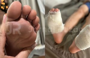 Criança volta com os pés queimados da escola em Canelinha e desabafa: “eu pedi para parar”
